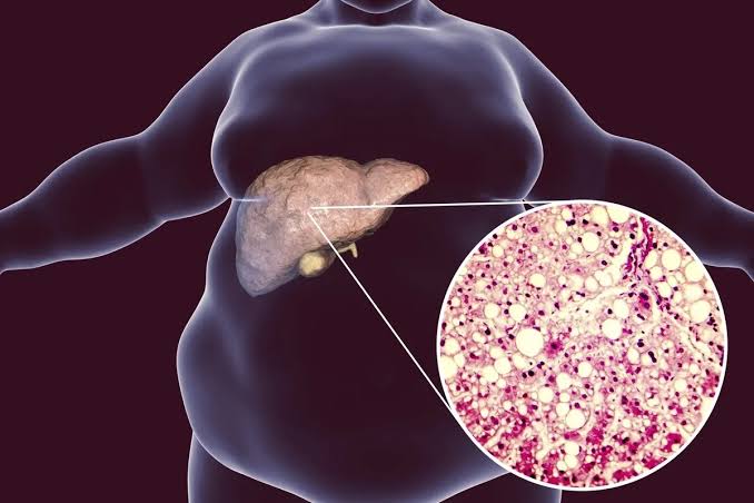 Why Does Fatty Liver Happen And How To Reverse It